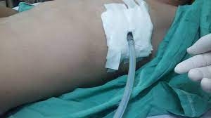 Hút dẫn lưu khoang màng phổi bằng máy hút áp lực âm liên tục