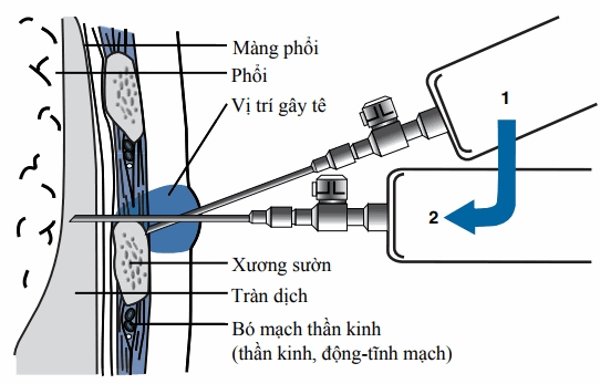 Siêu âm chẩn đoán màng phổi cấp cứu