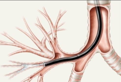 Lấy dị vật phế quản qua nội soi ống mềm