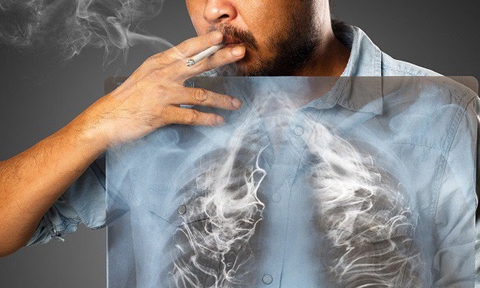 Thuốc lá là nguyên nhân chính gây ung thư phổi